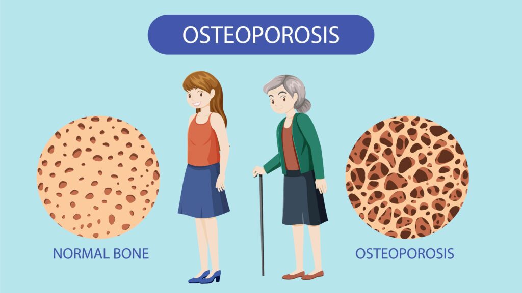 osteoporosis: enfermedad por falta de magnesio
